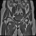 Abdominal wall endometriosis (Radiopaedia 83702-98847 Coronal T1 7).jpg