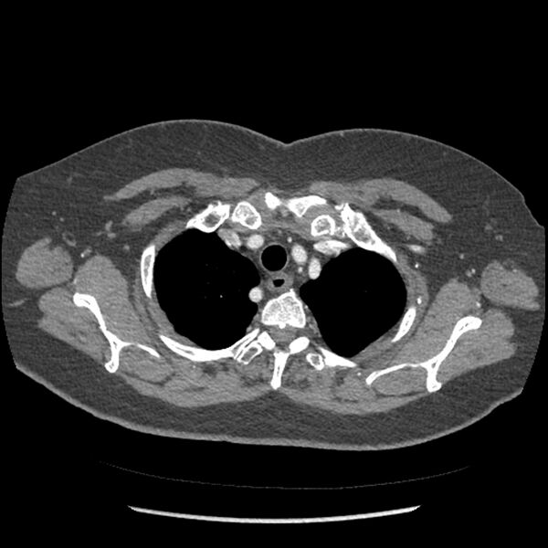 File:Aberrant right subclavian and left vertebral arteries (Radiopaedia 43467-46847 Axial C+ portal venous phase 19).jpg