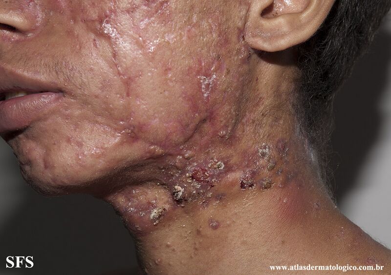File:Acne Fulminans (Dermatology Atlas 15).jpg
