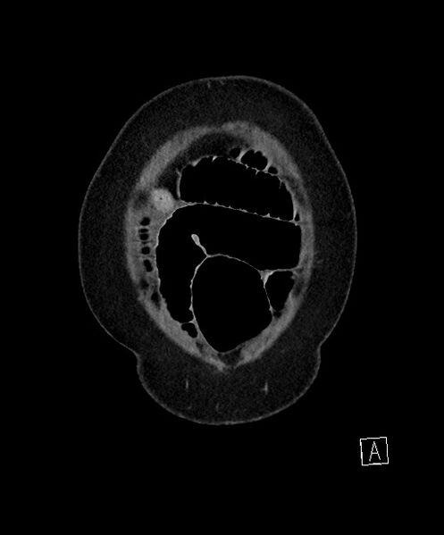 File:Active Crohn disease (Radiopaedia 59394-66750 Coronal C+ portal venous phase 9).jpg