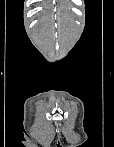 File:Active crohn disease (Radiopaedia 87133-103397 Coronal C+ arterial phase 65).jpg