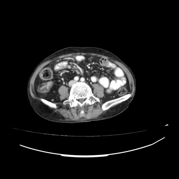 File:Acute-on-chronic Crohn disease with enteroenteric fistula (Radiopaedia 66686-75987 B 20).jpg