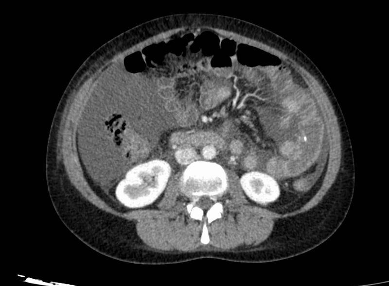 File:Acute Budd-Chiari syndrome (Radiopaedia 60858-68638 Axial C+ portal venous phase 153).jpg
