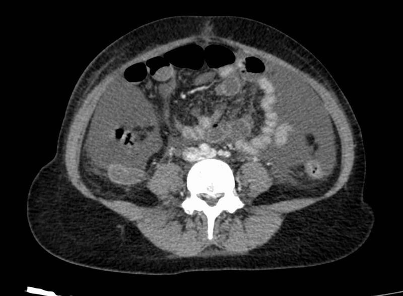 File:Acute Budd-Chiari syndrome (Radiopaedia 60858-68638 Axial C+ portal venous phase 189).jpg