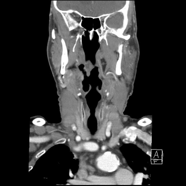 File:Acute ICA ischemic penumbra due to high-grade CCA stenosis (CT perfusion) (Radiopaedia 72038-82530 Coronal C+ arterial phase 13).jpg