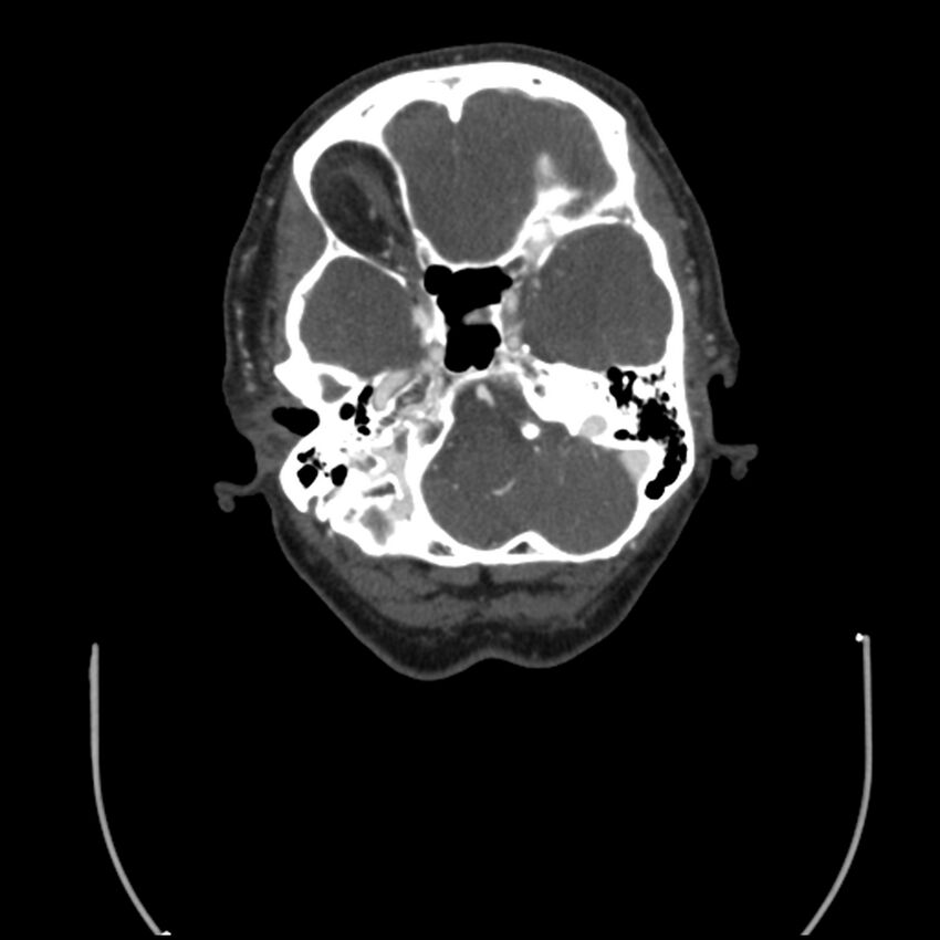 Acute M1 occlusion with ischemic penumbra (CT perfusion) (Radiopaedia 71897-82344 Axial C+ arterial phase thins 122).jpg
