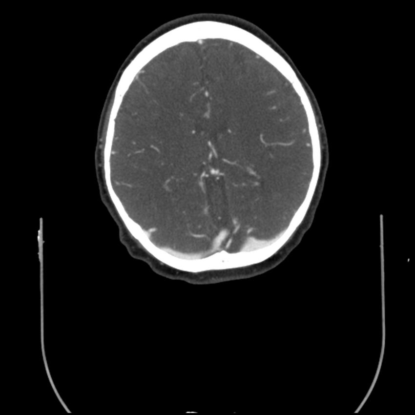 Acute M1 occlusion with ischemic penumbra (CT perfusion) (Radiopaedia 71897-82344 Axial C+ arterial phase thins 36).jpg