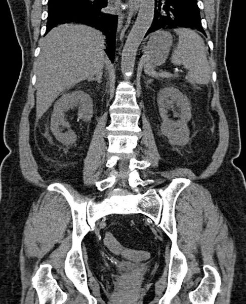 File:Acute appendicitis (Radiopaedia 58627-65818 Coronal non-contrast 48).jpg