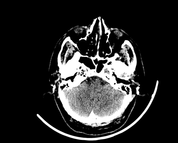 File:Acute cerebral infarct (Radiopaedia 35604-37123 Axial non-contrast 19).jpg