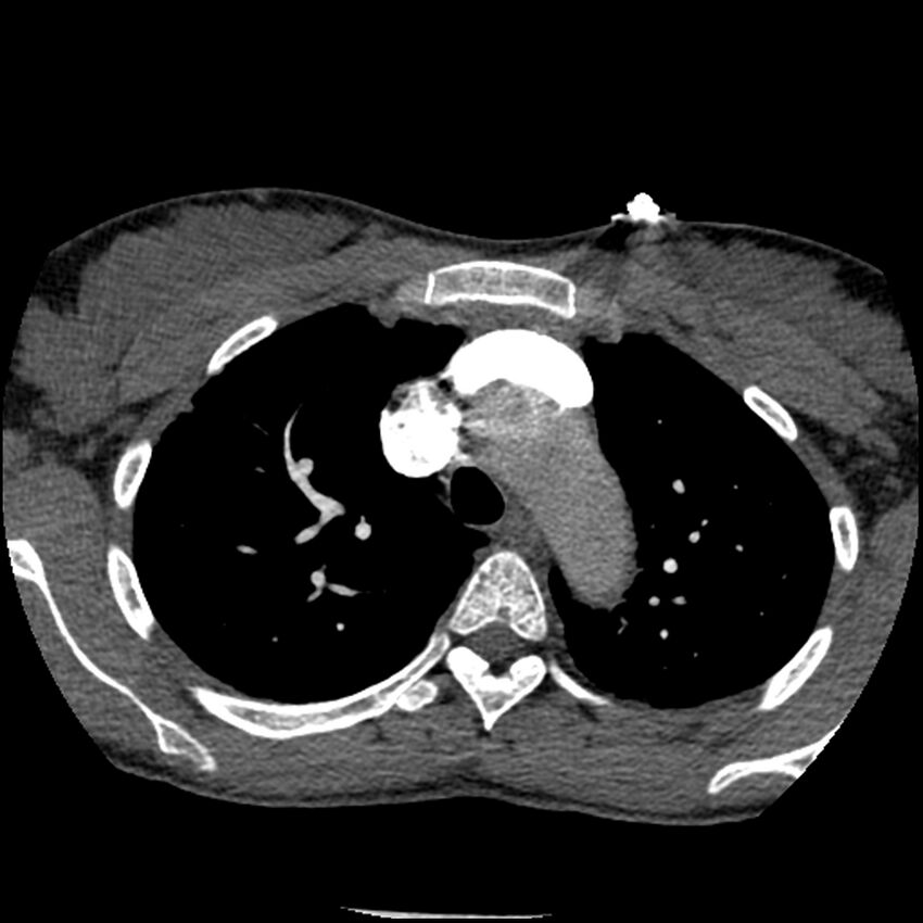 Acute chest syndrome - sickle cell disease (Radiopaedia 42375-45499 Axial C+ CTPA 53).jpg