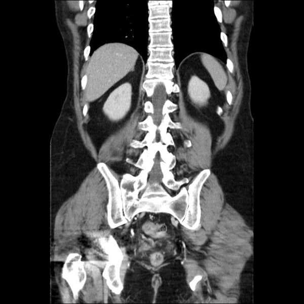 File:Acute cholecystitis and incidental left sided IVC (Radiopaedia 49352-54459 Coronal C+ portal venous phase 21).jpg
