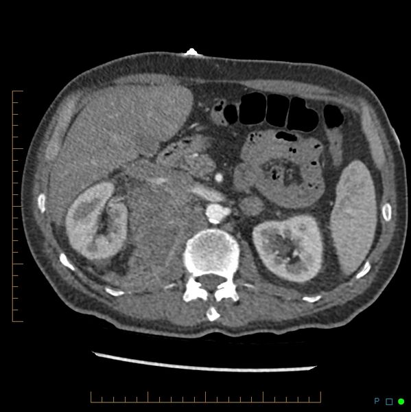 File:Acute hemorrhage into adrenal metastasis from NSCLC (Radiopaedia 43135-46429 Axial C+ arterial phase 10).jpg