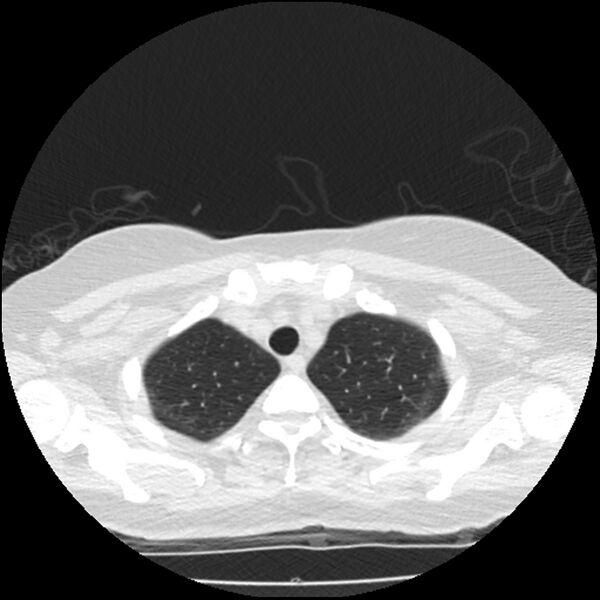 File:Acute interstitial pneumonitis (Radiopaedia 45404-49444 Axial lung window 15).jpg