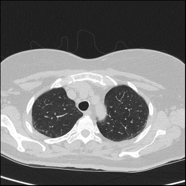 File:Acute interstitial pneumonitis (Radiopaedia 45404-49453 Axial lung window 18).jpg