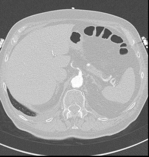 File:Acute myocardial infarction (Radiopaedia 23413-23481 lung window 74).jpg