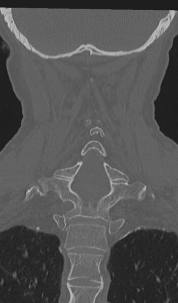 File:Acute on chronic subdural hematoma and thoracic vertebral injury in a multitrauma patient (Radiopaedia 31698-32619 Coronal bone window 44).jpg