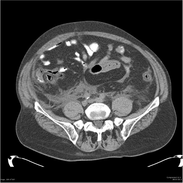 File:Acute pancreatitis (Radiopaedia 19135-19116 Axial non-contrast 43).jpg