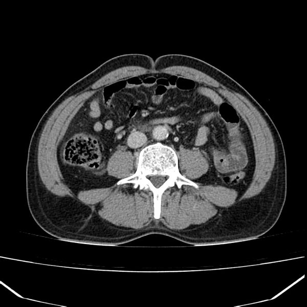 File:Acute pancreatitis (Radiopaedia 22572-22596 Axial C+ portal venous phase 42).jpg