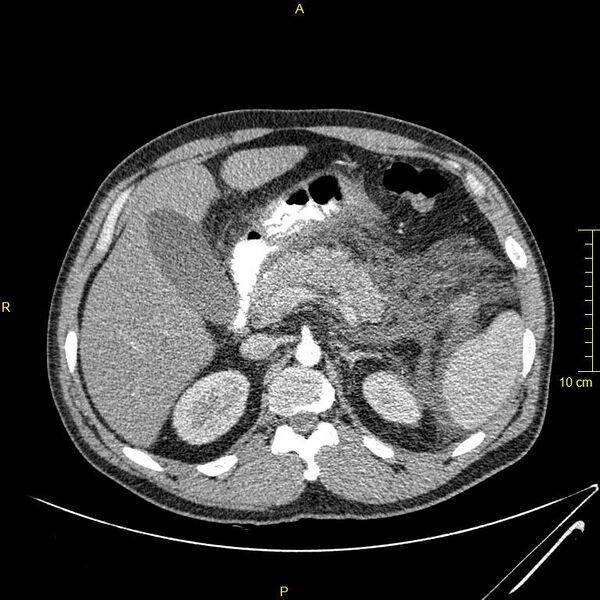 File:Acute pancreatitis (Radiopaedia 23231-23290 Axial C+ arterial phase 38).JPG
