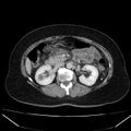 Acute pancreatitis - Balthazar C (Radiopaedia 26569-26714 Axial C+ portal venous phase 44).jpg