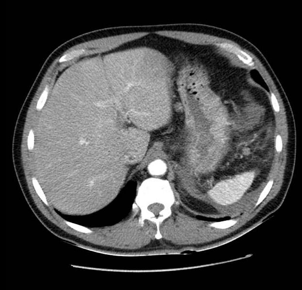 File:Acute pancreatitis - Balthazar E (Radiopaedia 23080-23110 Axial C+ arterial phase 14).jpg
