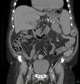 Acute renal failure post IV contrast injection- CT findings (Radiopaedia 47815-52557 Coronal non-contrast 19).jpg