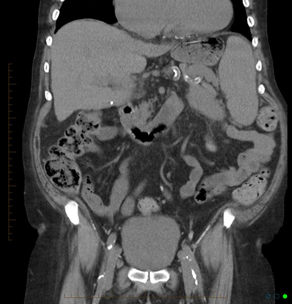 File:Acute renal failure post IV contrast injection- CT findings (Radiopaedia 47815-52557 Coronal non-contrast 19).jpg