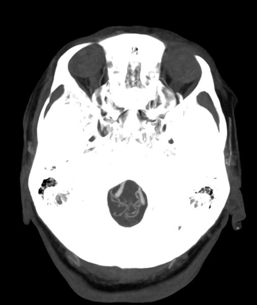 File:Acute right MCA M1 occlusion (Radiopaedia 62268-70454 Axial Phase 1 26).jpg