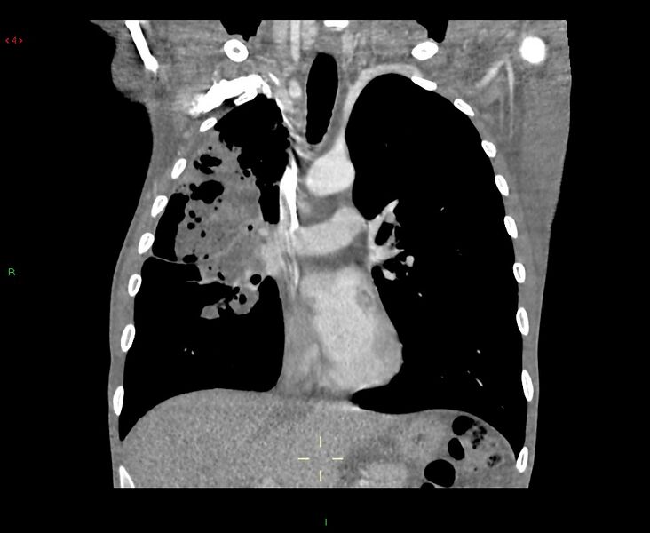 File:Acute right lung abscess (Radiopaedia 34806-36258 Coronal C+ arterial phase 32).jpg
