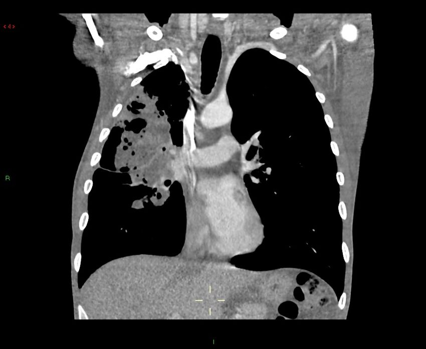 Acute right lung abscess (Radiopaedia 34806-36258 Coronal C+ arterial phase 32).jpg