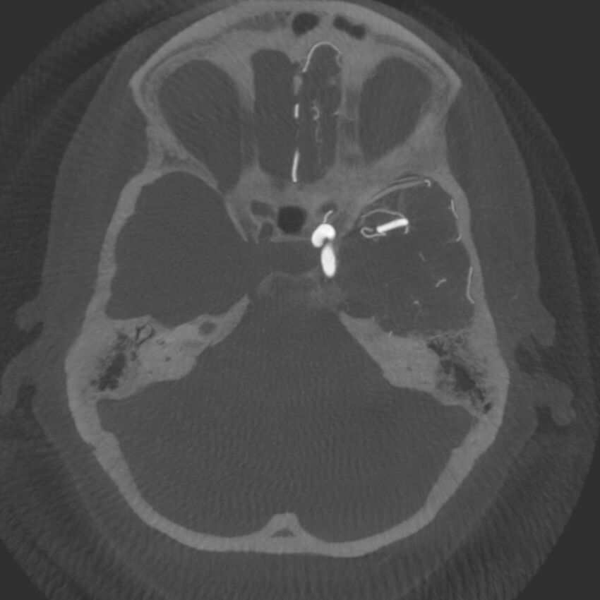 Acute subarachnoid hemorrhage and accessory anterior cerebral artery (Radiopaedia 69231-79010 C 16).jpg