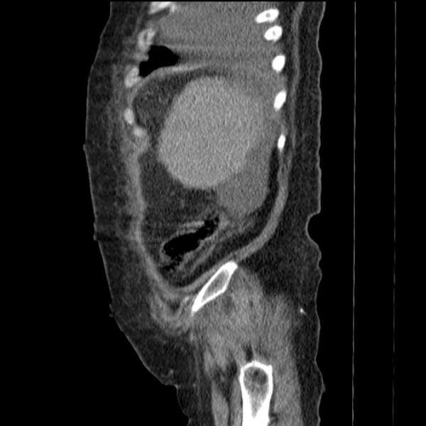 File:Acute tubular necrosis (Radiopaedia 28077-28334 H 16).jpg