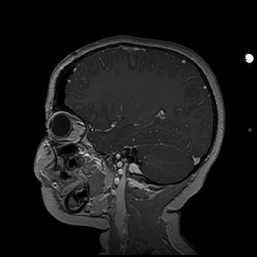 Adamantinomatous craniopharyngioma (Radiopaedia 77407-89529 H 40).jpg