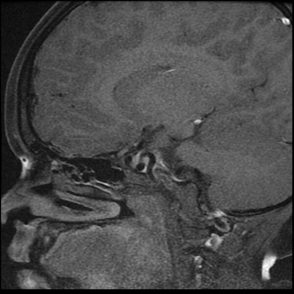 File:Adamantinomatous craniopharyngioma (Radiopaedia 77407-89529 Sagittal T1 C+ fat sat 12).jpg
