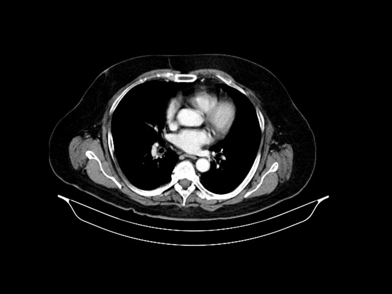 File:Adenocarcinoma of pancreas with hepatic metastasis (Radiopaedia 64332-73122 Axial C+ portal venous phase 5).jpg