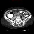 Adenocarcinoma of the colon (Radiopaedia 8191-9039 Axial renal excretory phase 36).jpg