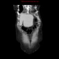 Adenocarcinoma of the colon (Radiopaedia 8191-9039 Coronal liver window 7).jpg