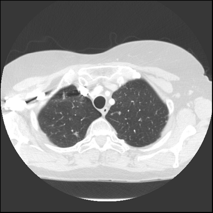 Adenocarcinoma of the lung (Radiopaedia 41015-43755 Axial lung window 20).jpg