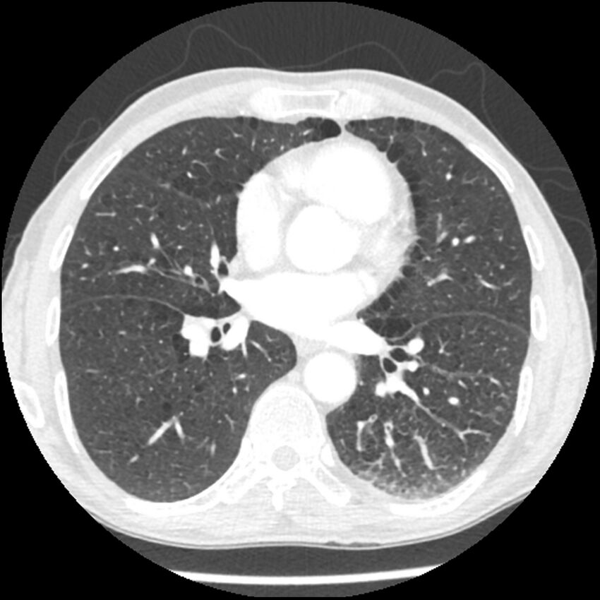 Adenocarcinoma of the lung - micropapillary predominant (Radiopaedia 42446-45563 C 63).jpg