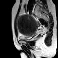 Adenomyoma of the uterus (huge) (Radiopaedia 9870-10438 Sagittal T2 17).jpg