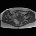 Adenomyosis and endometriotic cysts (Radiopaedia 82300-96367 Axial T1 14).jpg