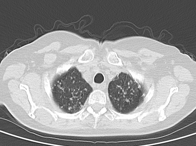 File:Adenosquamous lung carcinoma (Radiopaedia 22035-22030 lung window 16).jpg