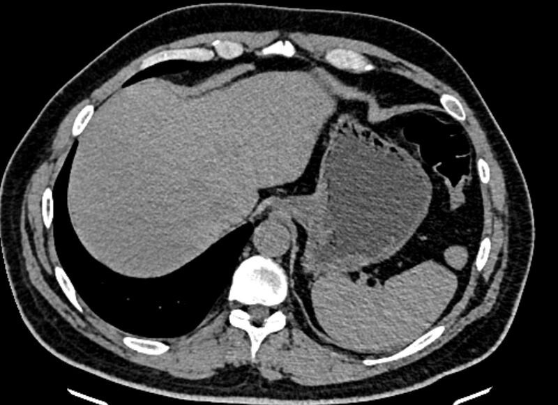 File:Adrenal metastases (Radiopaedia 73082-83791 Axial non-contrast 27).jpg