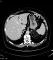 Adrenal myelolipoma (Radiopaedia 6765-7960 Axial C+ arterial phase 5).jpg