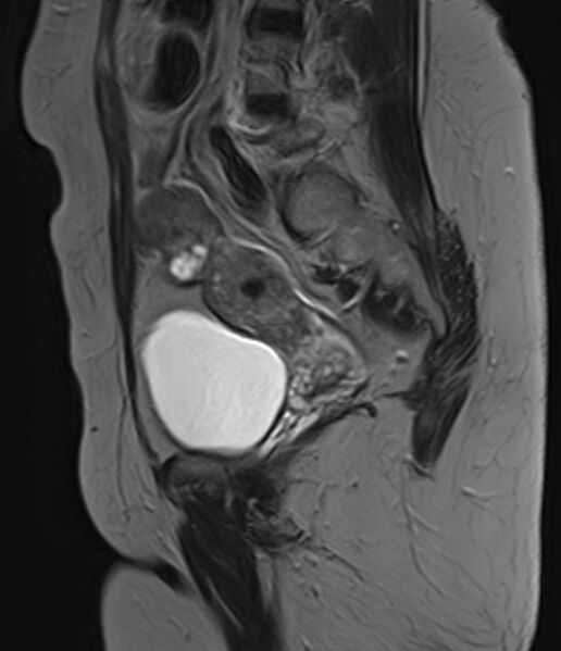 File:Adult granulosa cell tumor of the ovary (Radiopaedia 71581-81950 Sagittal T2 16).jpg