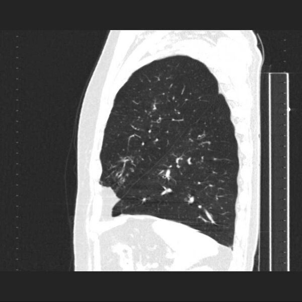 File:Allergic bronchopulmonary aspergillosis (Radiopaedia 21386-21320 Sagittal lung window 4).jpg