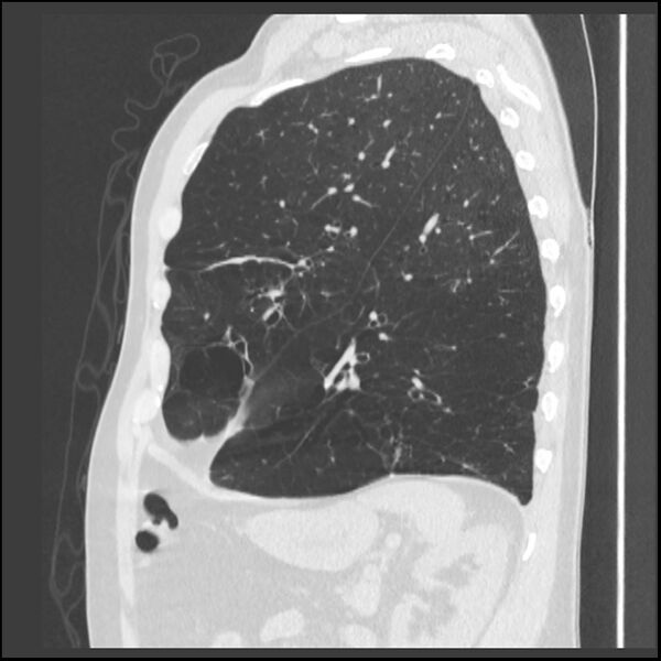 File:Alpha-1-antitrypsin deficiency (Radiopaedia 40993-43722 Sagittal lung window 75).jpg
