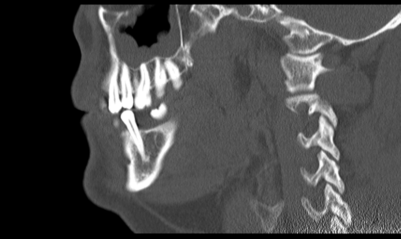 File:Ameloblastoma (Radiopaedia 33677-34806 Sagittal bone window 40).png
