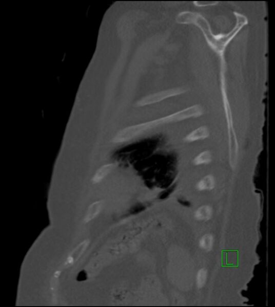 File:Amiodarone deposition in the liver (Radiopaedia 77587-89780 Sagittal bone window 19).jpg