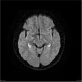 Amnestic syndrome secondary to hypoxic brain injury (Radiopaedia 24743-25004 DWI 14).jpg